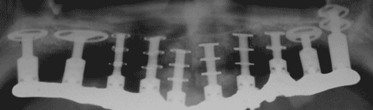 Boi-Implantate